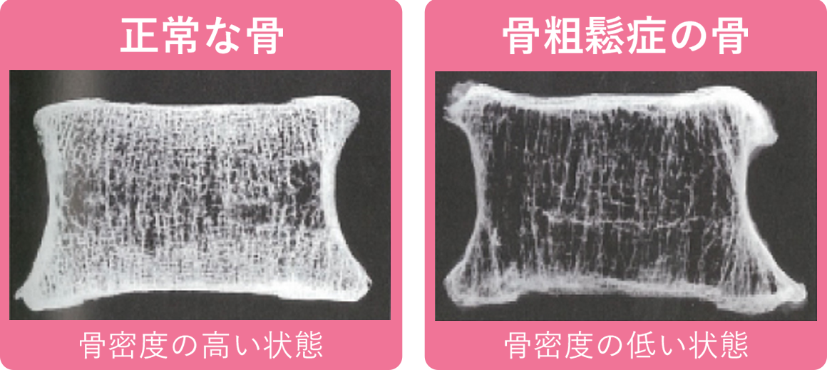 正常な骨と骨粗鬆症の骨