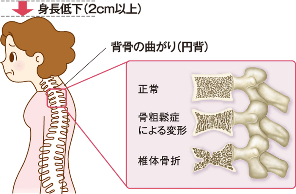 50代女性の9人に1人、60代女性の3人に1人、70代女性の2人に1人